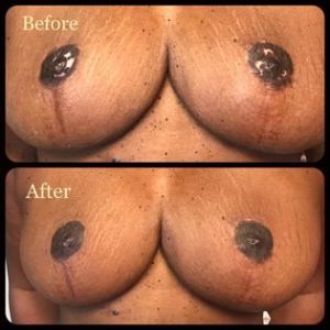 Pigment Loss Areola Coloration
