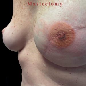 Single Mastectomy 3d perspective view of areola tattoo