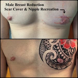 Male Breast Reduction Botch Areola Nipple Scar Coverup
