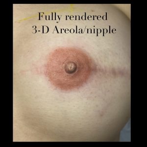 Mastectomy 3d areola nipple recreation