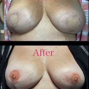 3d double mastectomy areola scar coverup tattoo